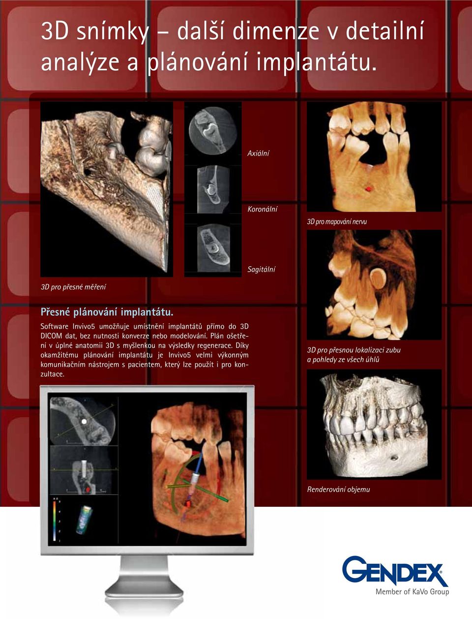 Software Invivo5 umožňuje umístnění implantátů přímo do 3D DICOM dat, bez nutnosti konverze nebo modelování.