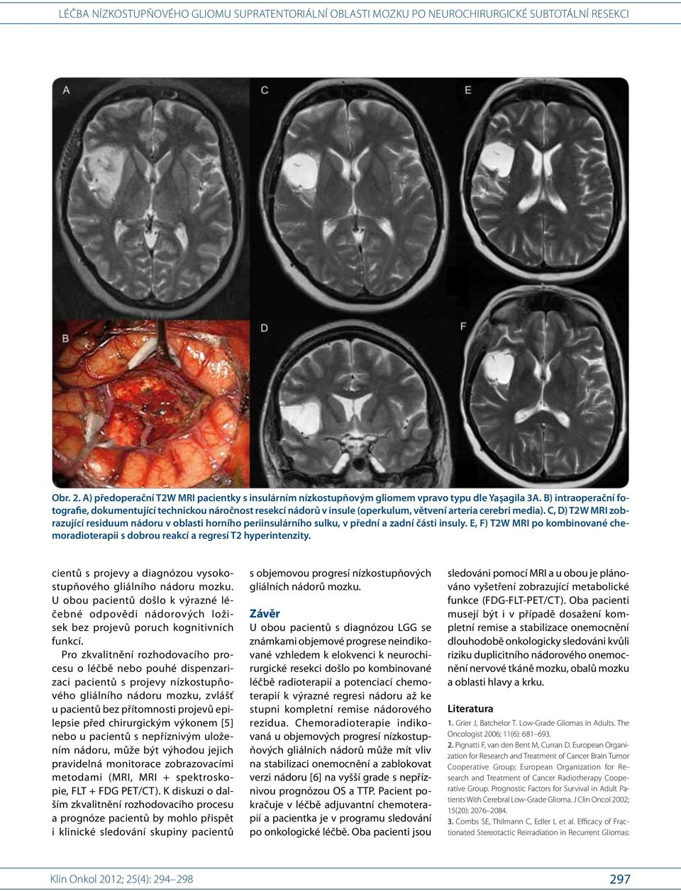 B) intraoperační fotografie, dokumentující technickou náročnost resekcí nádorů v insule (operkulum, větvení arteria cerebri media).