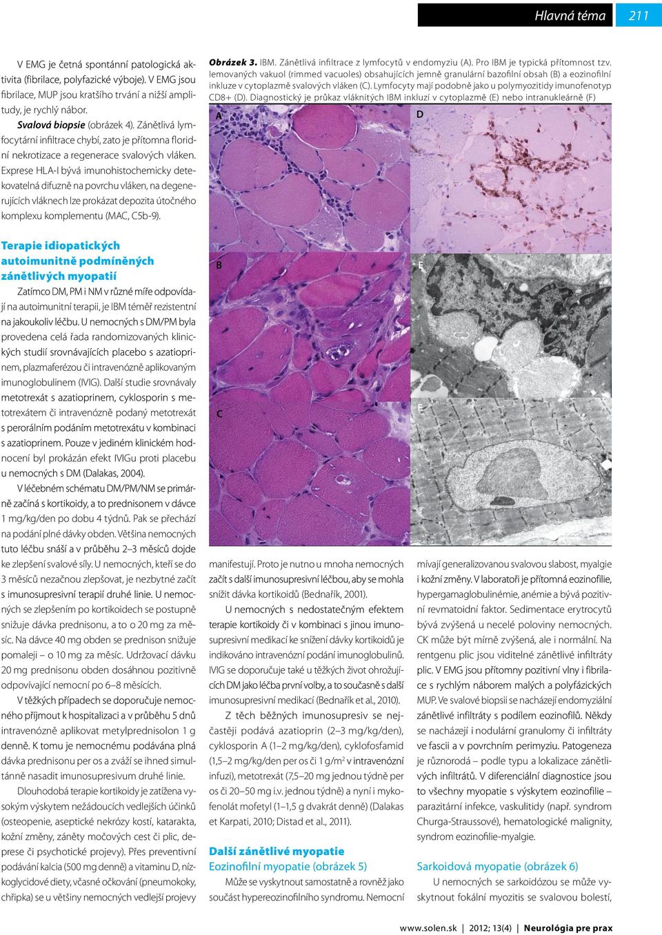 Exprese HLA-I bývá imunohistochemicky detekovatelná difuzně na povrchu vláken, na degenerujících vláknech lze prokázat depozita útočného komplexu komplementu (MAC, C5b-9). Obrázek 3. IBM.