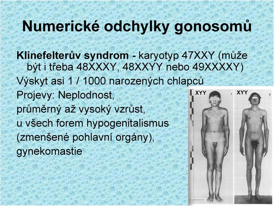 narozených chlapců Projevy: Neplodnost, průměrný až vysoký vzrůst,