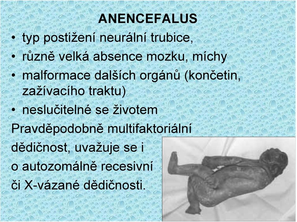 traktu) neslučitelné se životem Pravděpodobně multifaktoriální