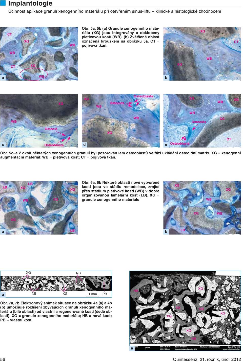 5c e V okolí některých xenogenních grnulí yl pozorován lem osteolstů ve fázi ukládání osteoidní mtrix. = xenogenní ugmentční mteriál; = pletivová kost; = pojivová tkáň. Or.