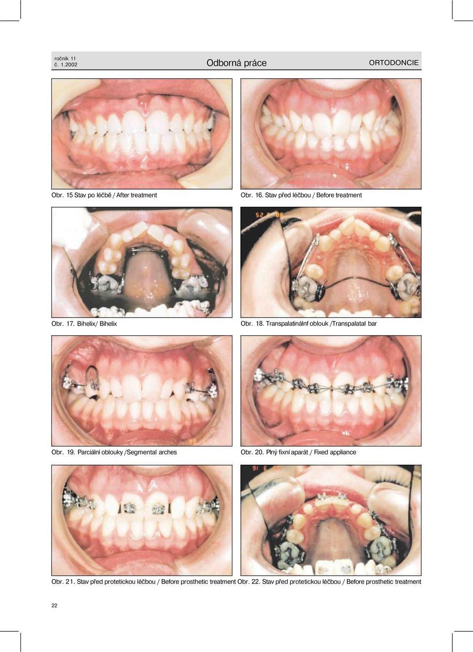 Transpalatinálnf oblouk /Transpalatal bar Obr. 19. Parciální oblouky /Segmental arches Obr. 20.