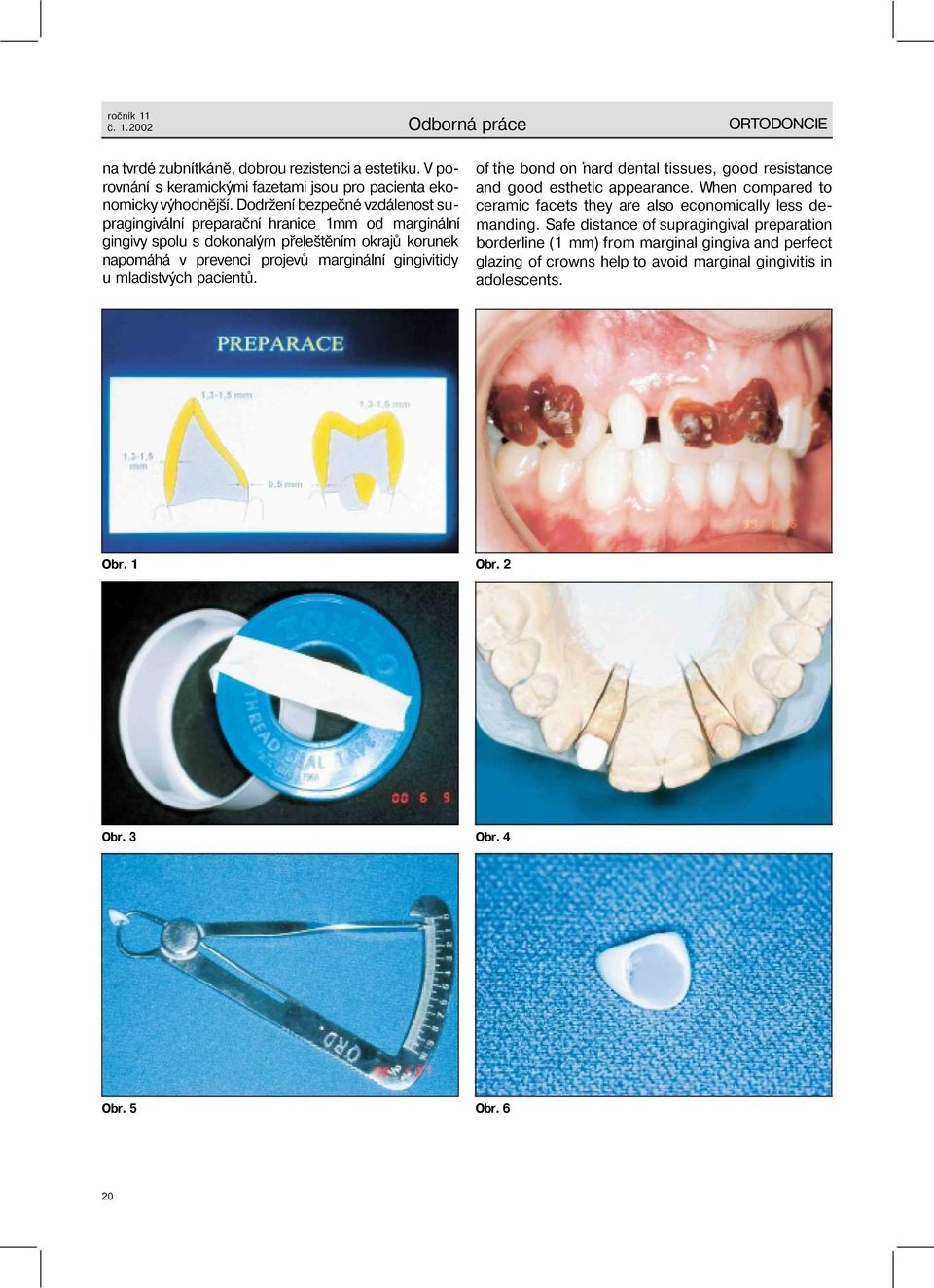 u mladistvých pacientů. of tne bond on nard dental tissues, good resistance and good esthetic appearance. When compared to ceramic facets they are also economically less demanding.