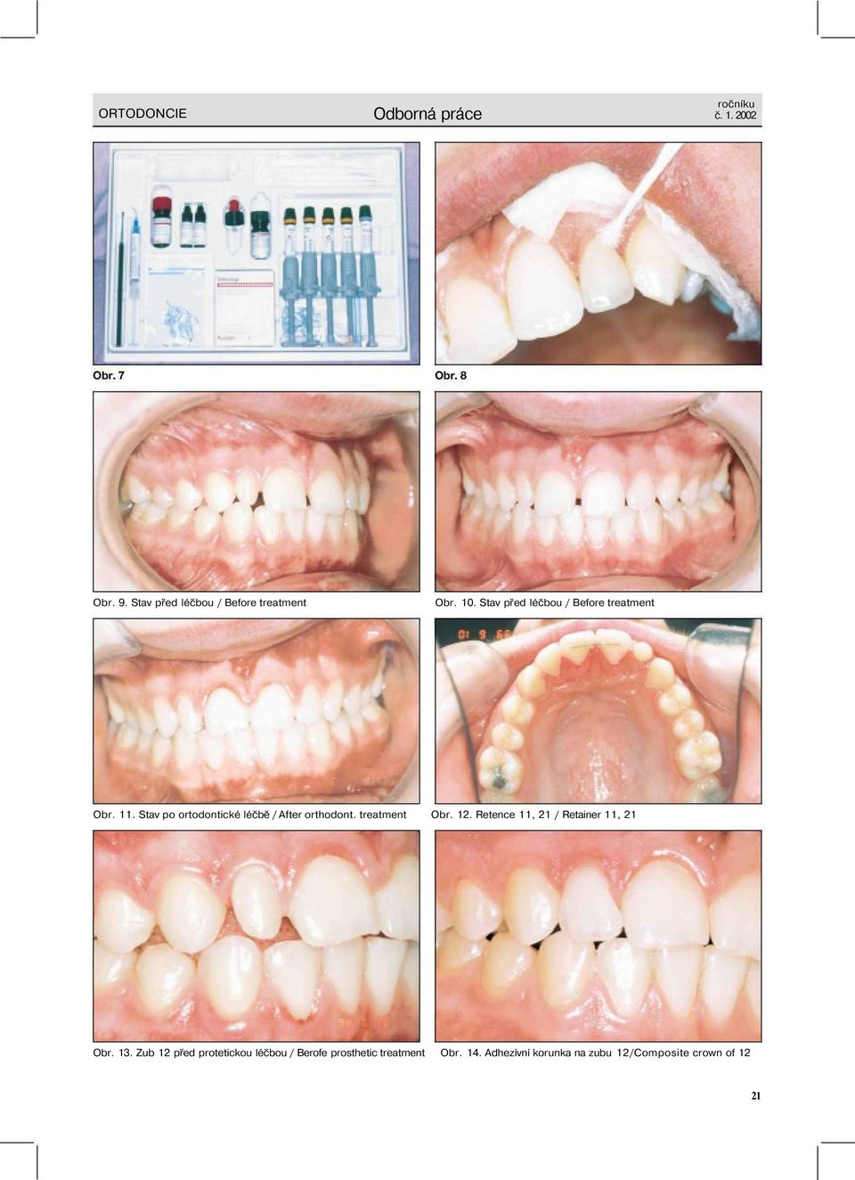 Stav po ortodontické léčbě / After orthodont. treatment Obr. 12.