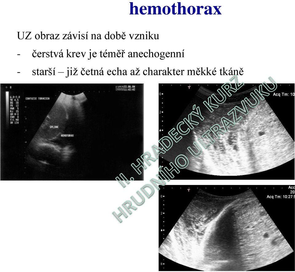 téměř anechogenní - starší již