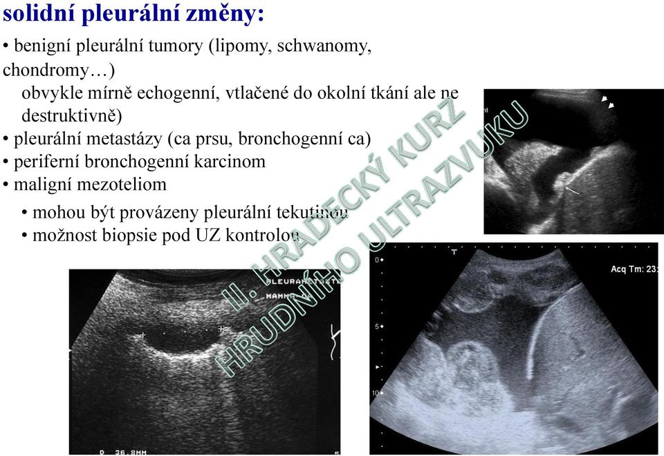 pleurální metastázy (ca prsu, bronchogenní ca) periferní bronchogenní karcinom