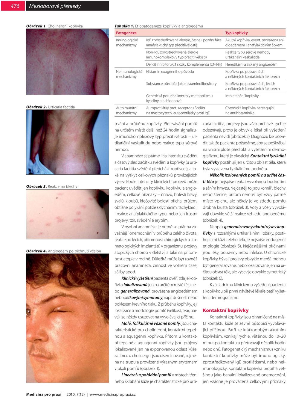 přecitlivělosti) Non-IgE zprostředkovaná alergie (imunokomplexový typ přecitlivělosti) Deficit inhibitoru C1 složky komplementu (C1-INH) Histamin exogenního původu Substance působící jako