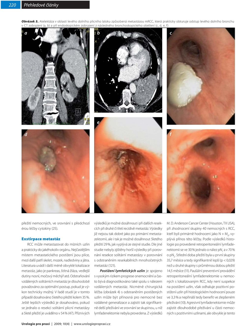 bronchoskopického ošetření (c, d, e, f) a b c e d f přežití nemocných, ve srovnání s předchozí érou léčby cytokiny (25).