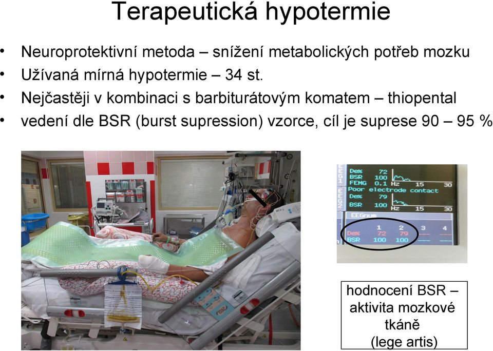 Nejčastěji v kombinaci s barbiturátovým komatem thiopental vedení dle