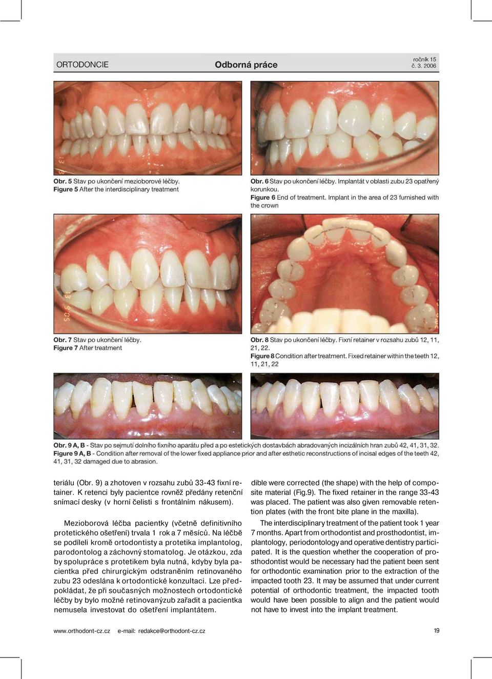 Je otázkou, zda by spolupráce s protetikem byla nutná, kdyby byla pacientka před chirurgickým odstraněním retinovaného zubu 23 odeslána k ortodontické konzultaci.