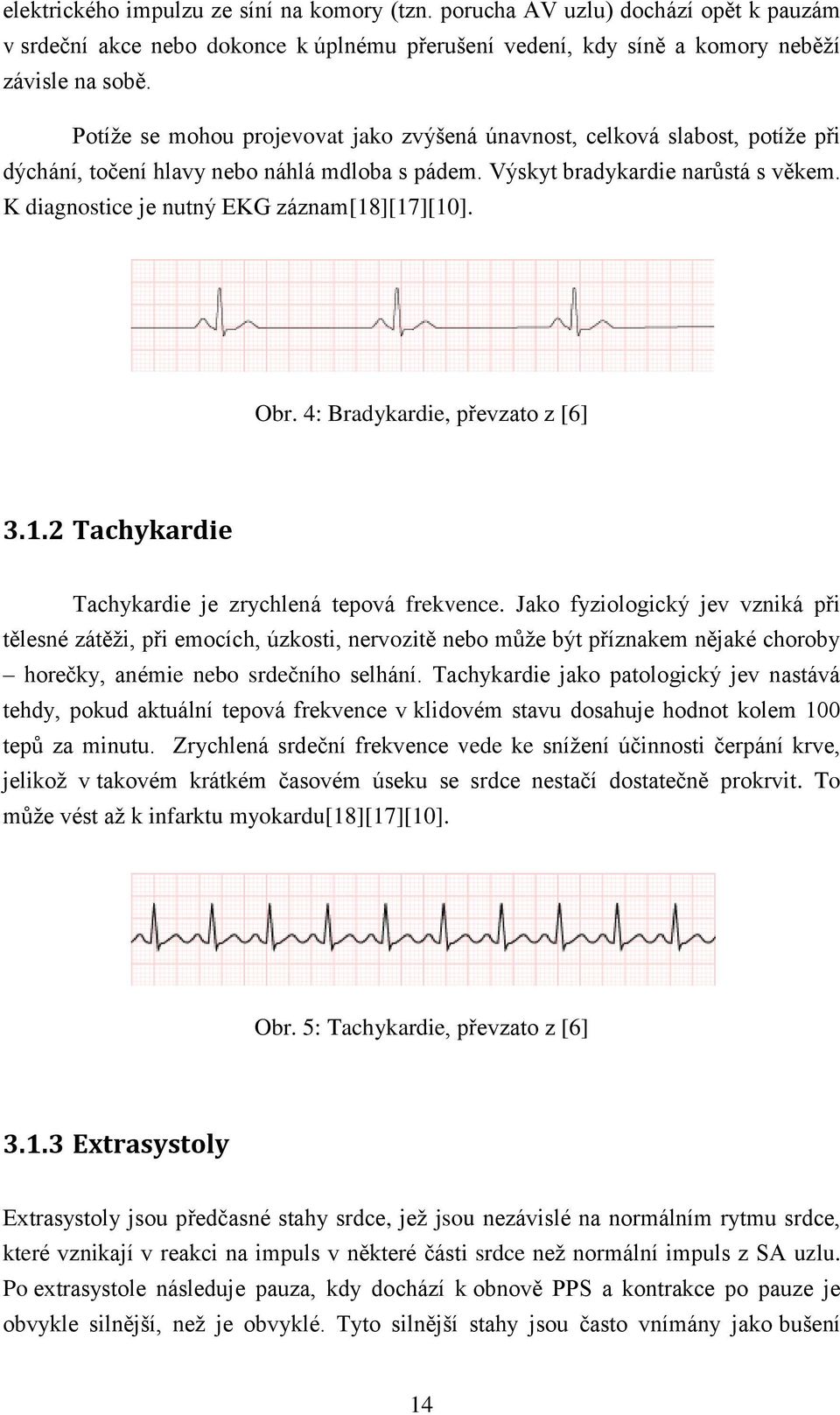 K diagnostice je nutný EKG záznam[18][17][10]. Obr. 4: Bradykardie, převzato z [6] 3.1.2 Tachykardie Tachykardie je zrychlená tepová frekvence.