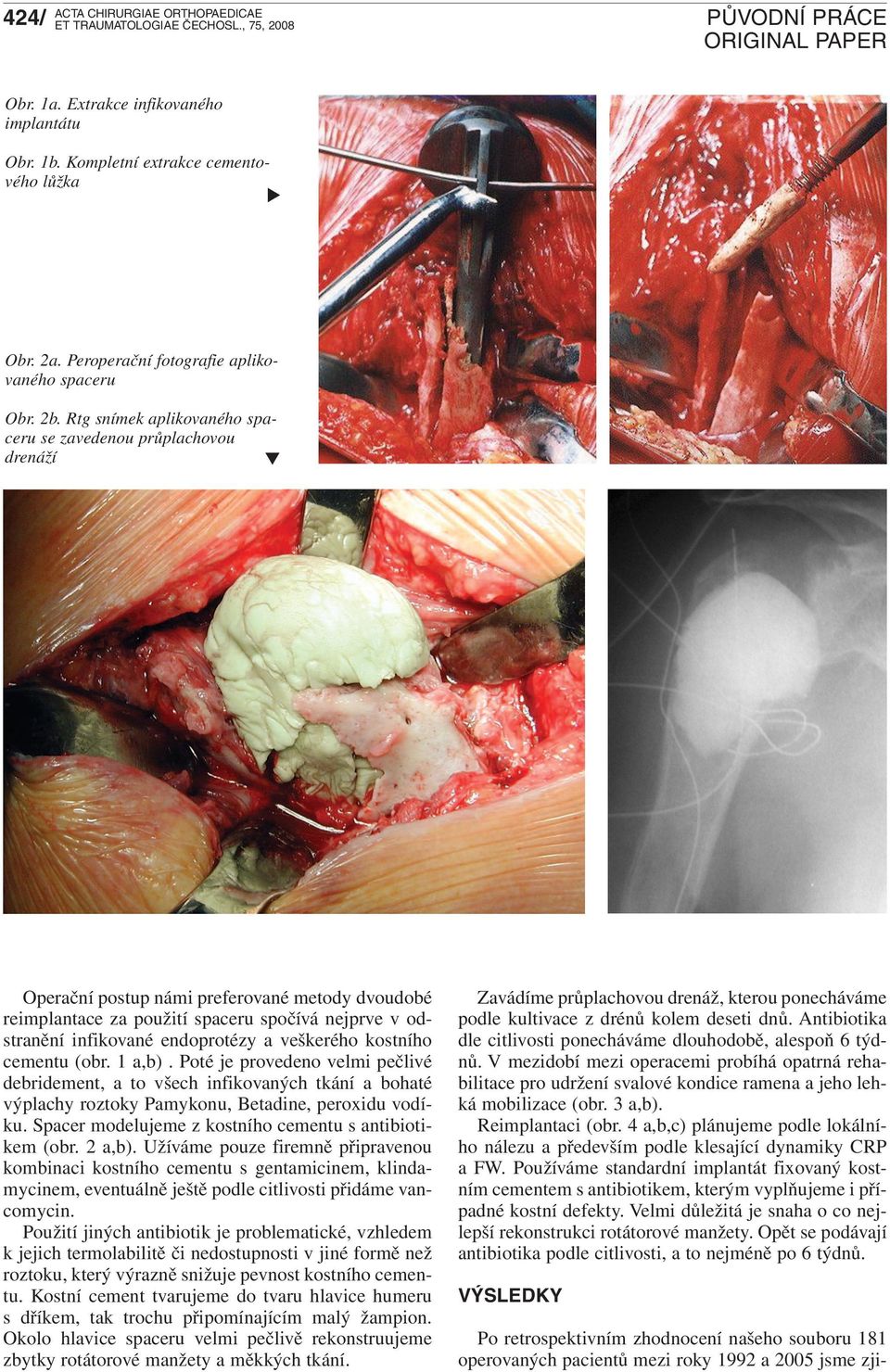a veškerého kostního cementu (obr. 1 a,b). Poté je provedeno velmi pečlivé debridement, a to všech infikovaných tkání a bohaté výplachy roztoky Pamykonu, Betadine, peroxidu vodíku.