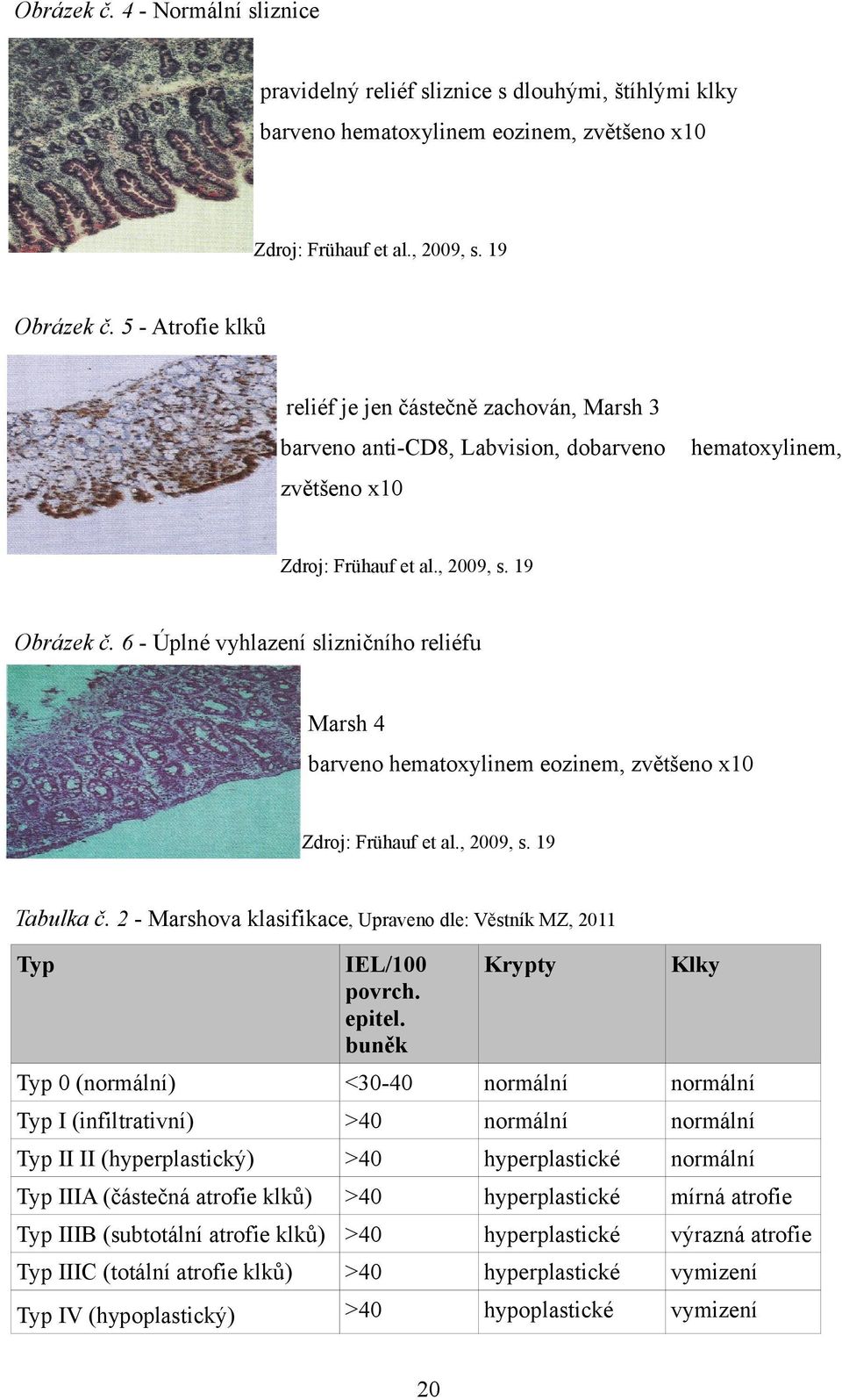 6 - Úplné vyhlazení slizničního reliéfu Marsh 4 barveno hematoxylinem eozinem, zvětšeno x10 Zdroj: Frühauf et al., 2009, s. 19 Tabulka č.