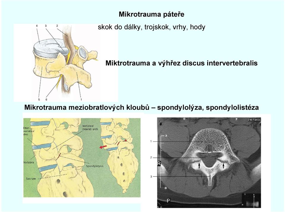 výhřez discus intervertebralis