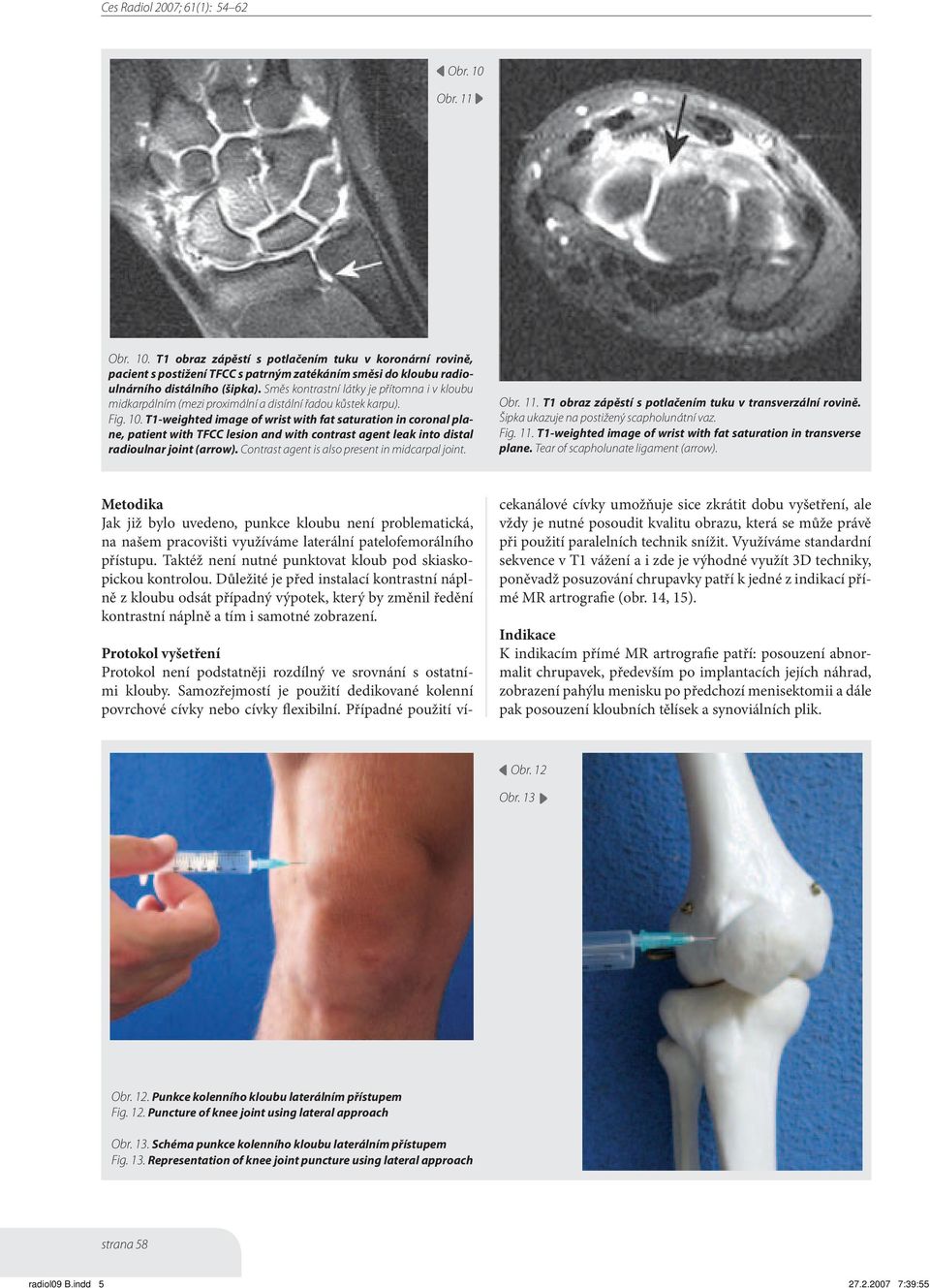 T1-weighted image of wrist with fat saturation in coronal plane, patient with TFCC lesion and with contrast agent leak into distal radioulnar joint (arrow).