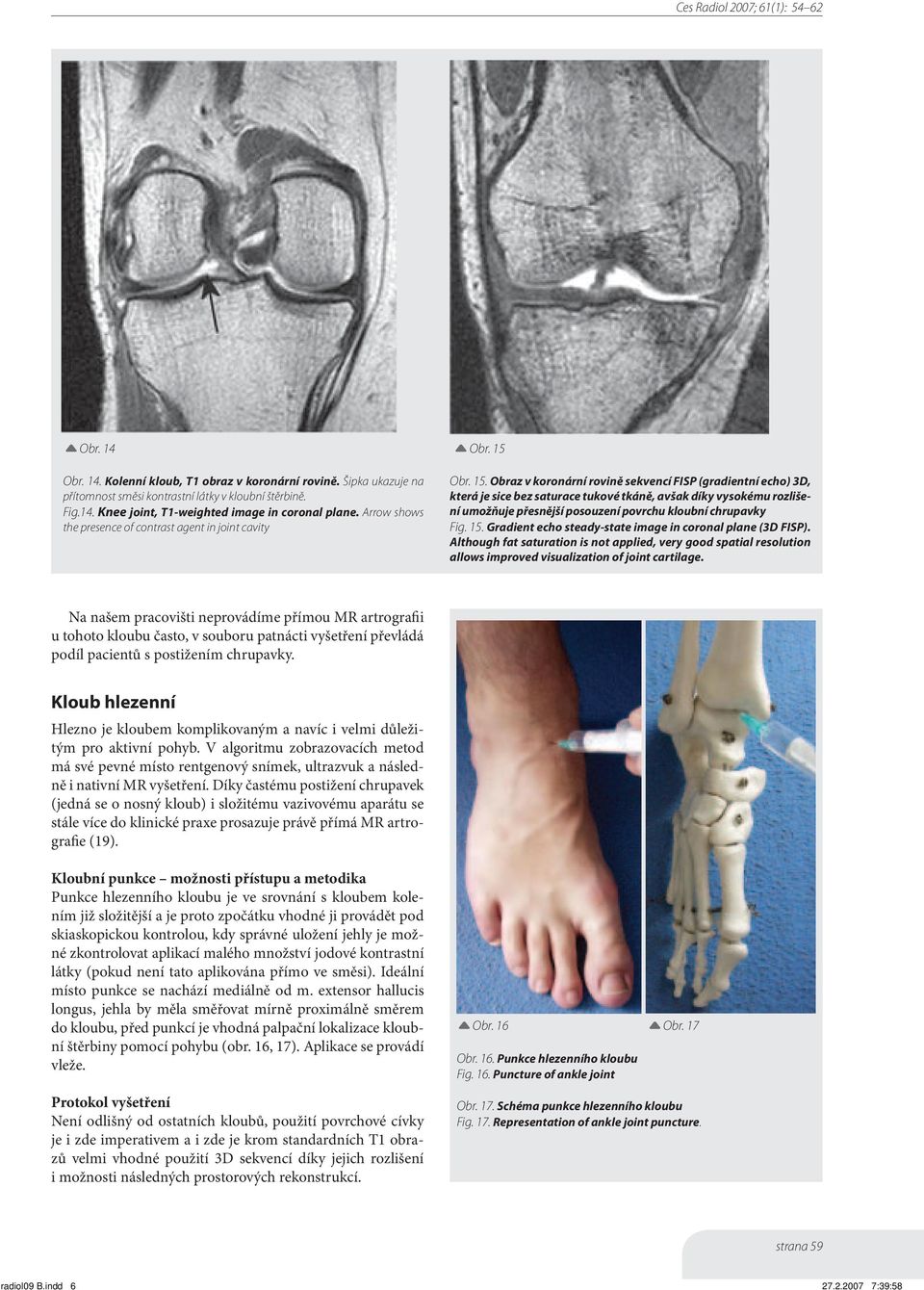 Obraz v koronární rovině sekvencí FISP (gradientní echo) 3D, která je sice bez saturace tukové tkáně, avšak díky vysokému rozlišení umožňuje přesnější posouzení povrchu kloubní chrupavky Fig. 15.