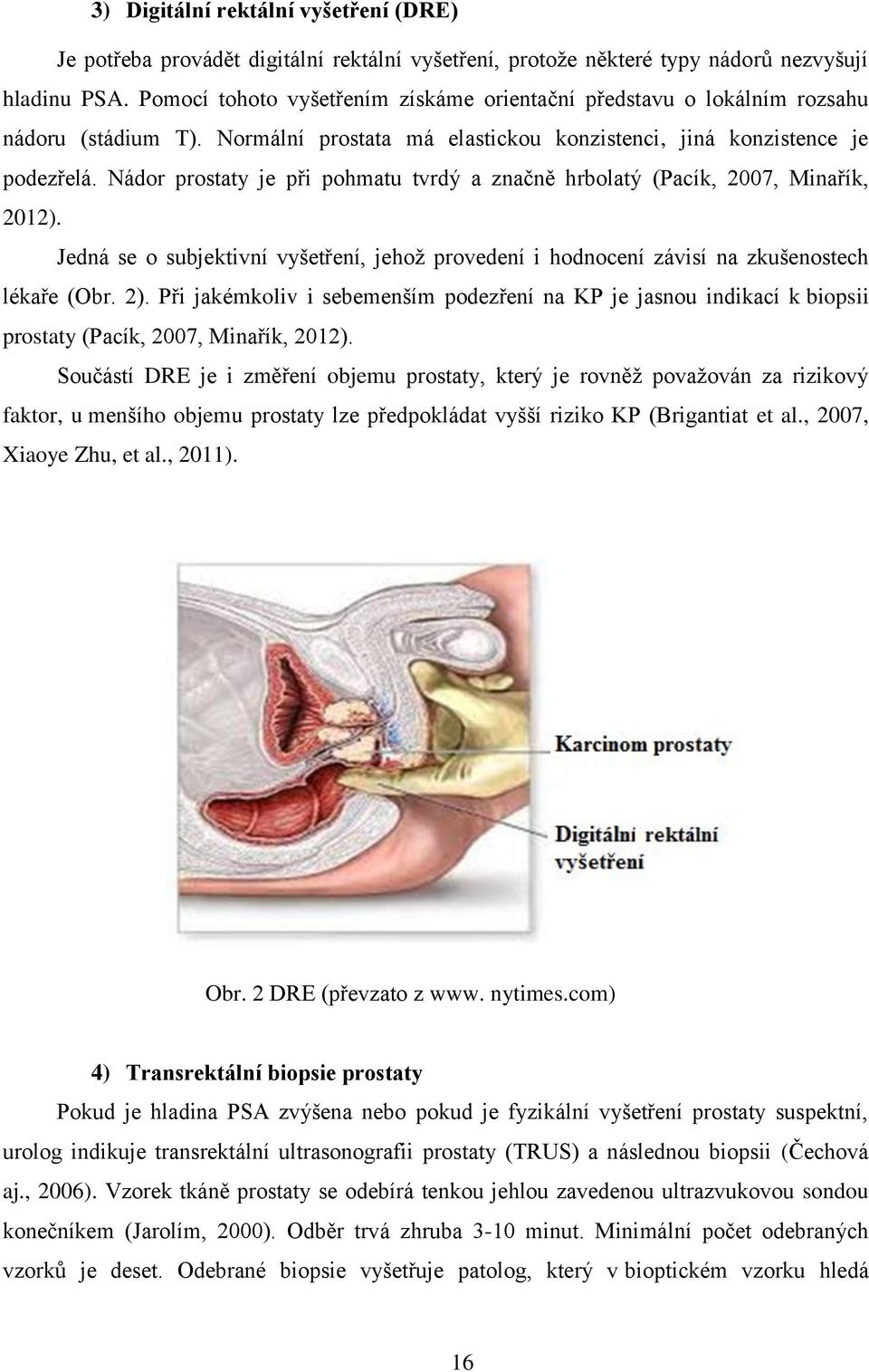 Nádor prostaty je při pohmatu tvrdý a značně hrbolatý (Pacík, 2007, Minařík, 2012). Jedná se o subjektivní vyšetření, jehož provedení i hodnocení závisí na zkušenostech lékaře (Obr. 2).