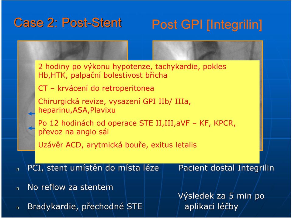 Po 12 hodinách od operace STE II,III,aVF KF, KPCR, převoz na angio sál Uzávěr ACD, arytmická bouře, exitus letalis PCI,