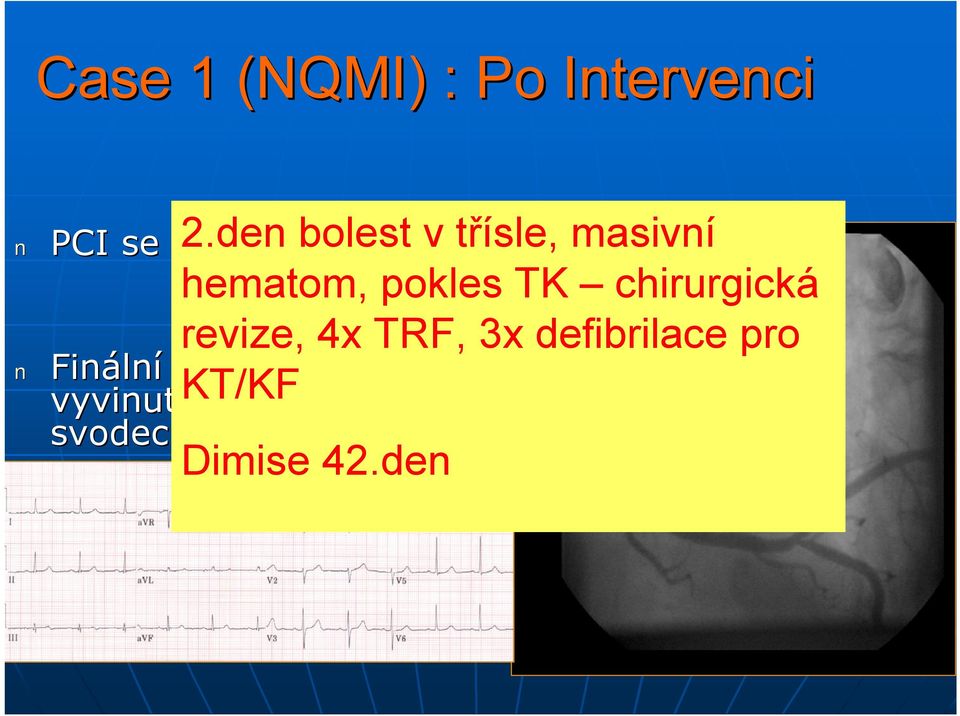 revize, 4x TRF, 3x defibrilace pro PCI se stent entemem na