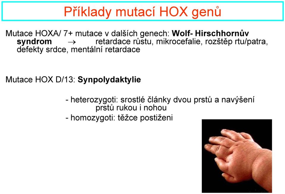 defekty srdce, mentální retardace Mutace HOX D/13: Synpolydaktylie -