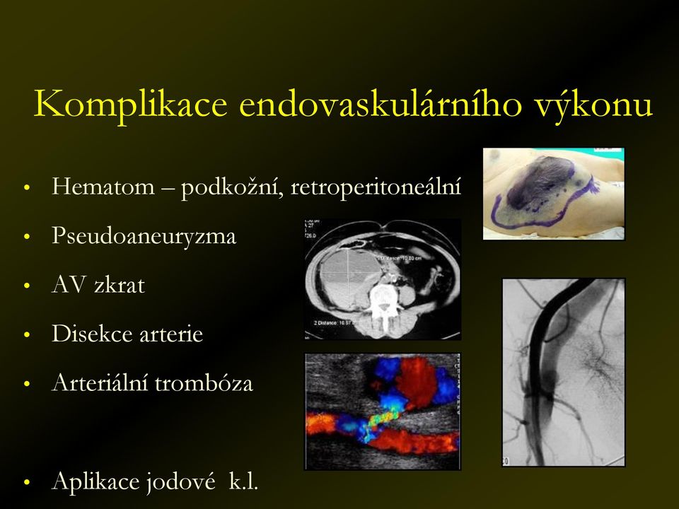 Pseudoaneuryzma AV zkrat Disekce