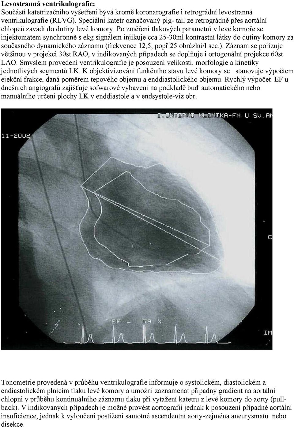 Po změření tlakových parametrů v levé komoře se injektomatem synchronně s ekg signálem injikuje cca 25-30ml kontrastní látky do dutiny komory za současného dynamického záznamu (frekvence 12,5, popř.