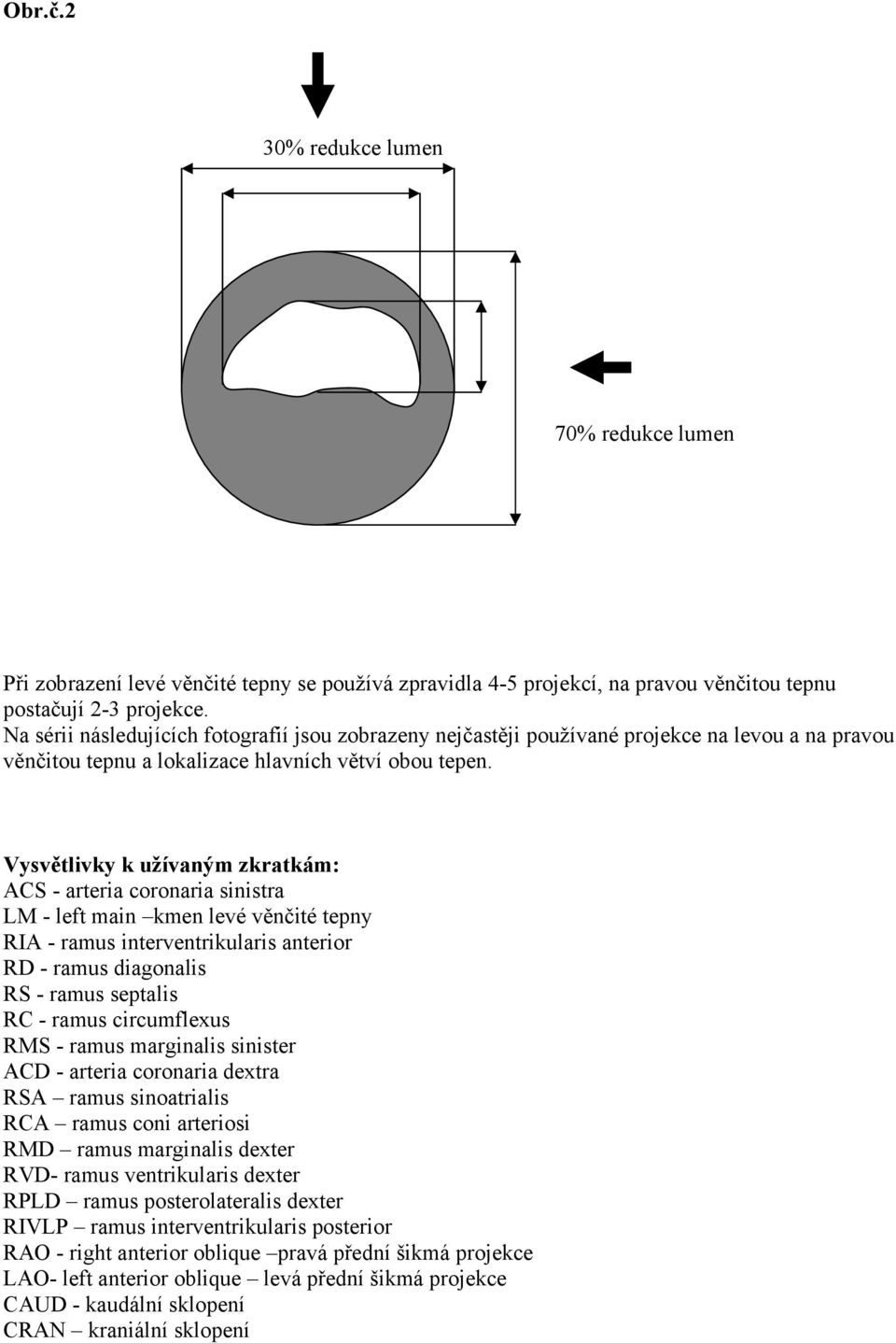 Vysvětlivky k užívaným zkratkám: ACS - arteria coronaria sinistra LM - left main kmen levé věnčité tepny RIA - ramus interventrikularis anterior RD - ramus diagonalis RS - ramus septalis RC - ramus
