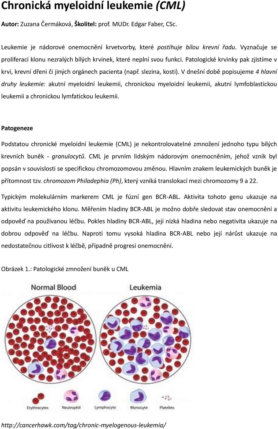 V dnešní době popisujeme 4 hlavní druhy leukemie: akutní myeloidní leukemii, chronickou myeloidní leukemii, akutní lymfoblastickou leukemii a chronickou lymfatickou leukemii.