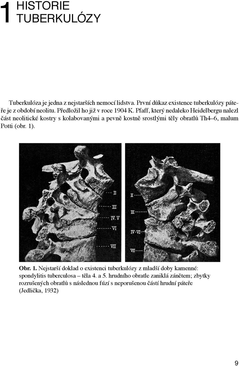 Pfaff, který nedaleko Heidelbergu nalezl část neolitické kostry s kolabovanými a pevně kostně srostlými těly obratlů Th4 6, malum Potti