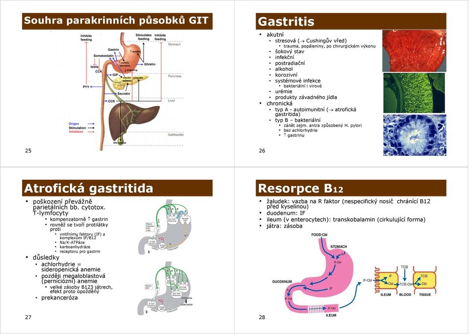 pylori bez achlorhydrie gastrinu 25 26 Atrofická gastritida prekanceróza poškození převážně parietálních bb. cytotox.