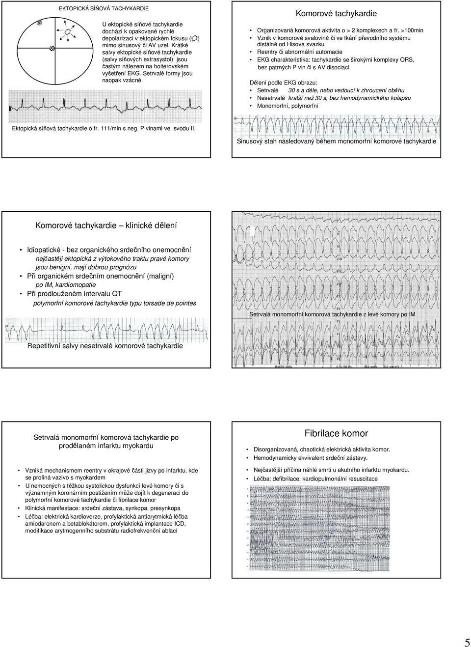 Komorové tachykardie Organizovaná komorová aktivita o > komplexech a fr.