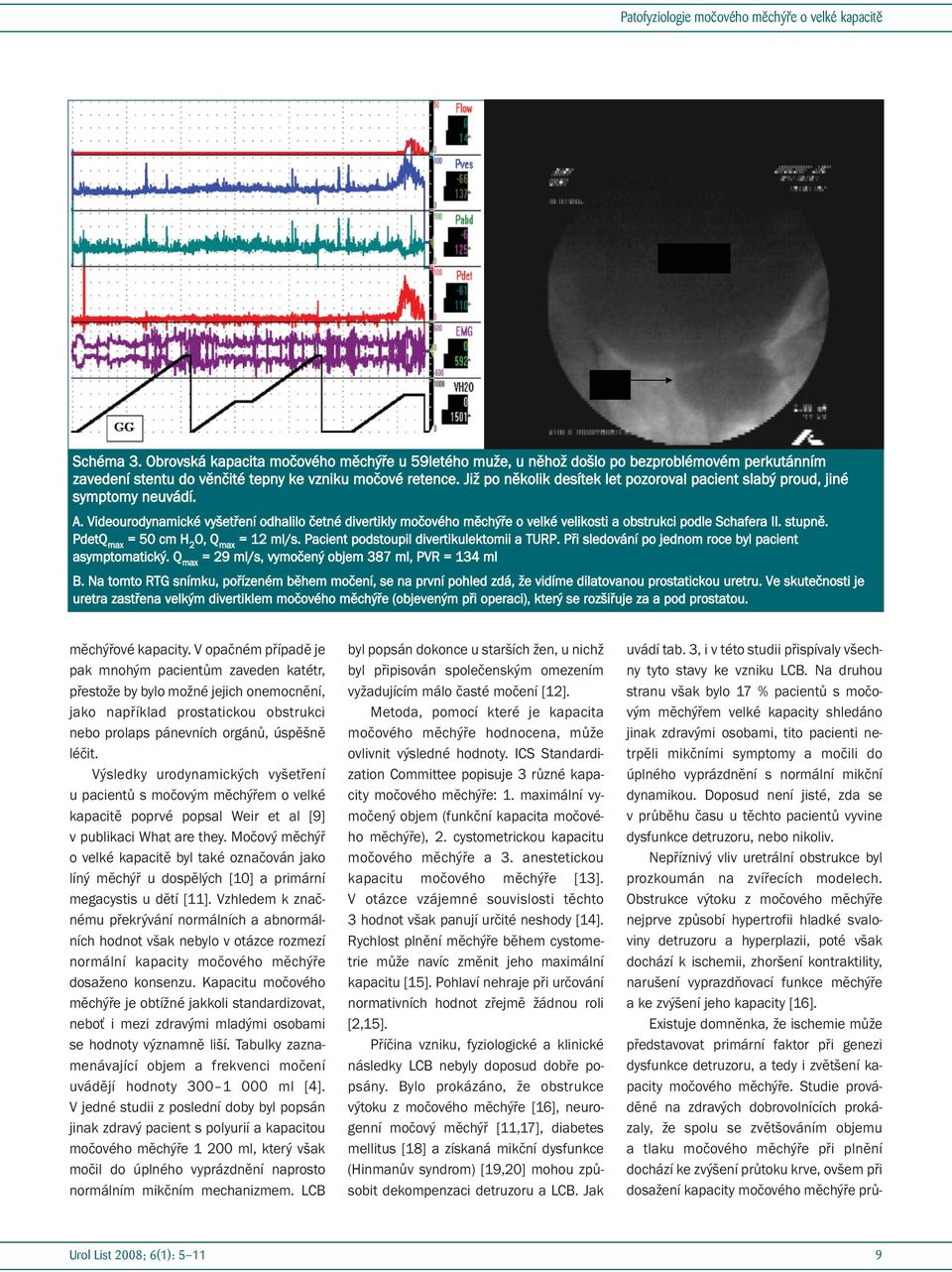 Videourodynamické vyšetření odhalilo četné divertikly močového měchýře o velké velikosti a obstrukci podle Schafera II. stupně. PdetQ max = 50 cm H 2 O, Q max = 12 ml/s.