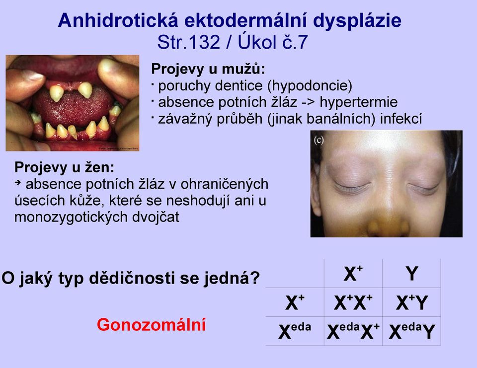 průběh (jinak banálních) infekcí Projevy u žen: absence potních žláz v ohraničených úsecích