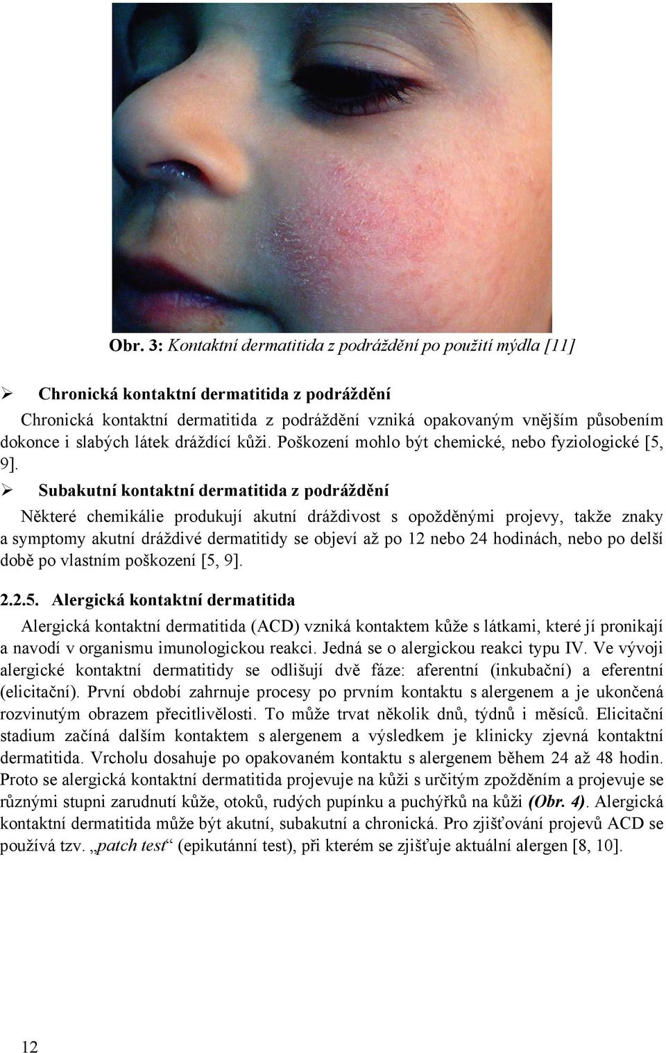 Subakutní kontaktní dermatitida z podráždění Některé chemikálie produkují akutní dráždivost s opožděnými projevy, takže znaky a symptomy akutní dráždivé dermatitidy se objeví až po 12 nebo 24