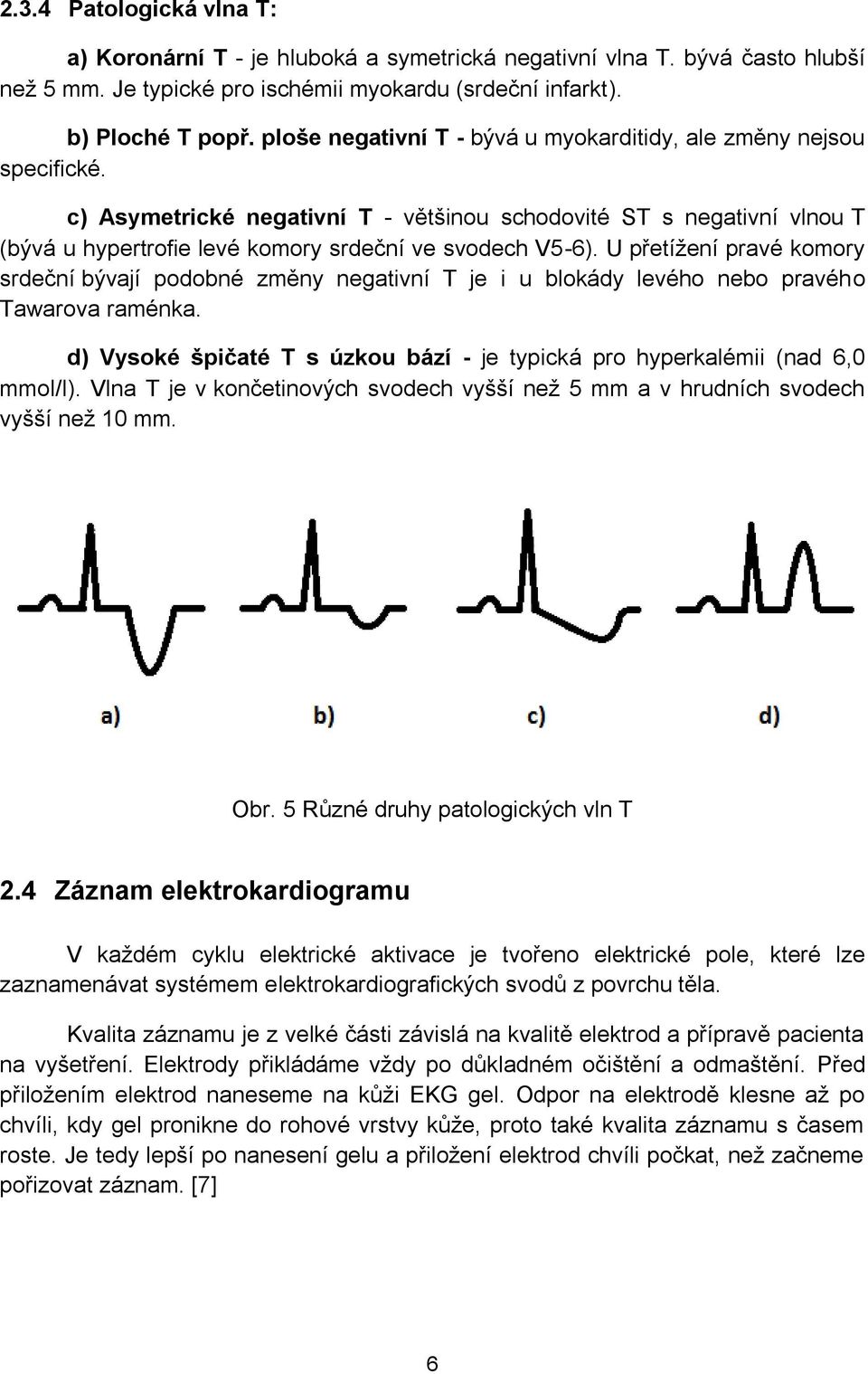 U přetížení pravé komory srdeční bývají podobné změny negativní T je i u blokády levého nebo pravého Tawarova raménka. d) Vysoké špičaté T s úzkou bází - je typická pro hyperkalémii (nad 6,0 mmol/l).