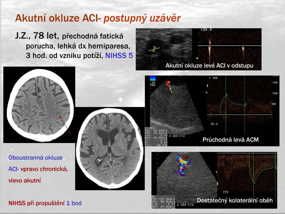 od vzniku potíží, NIHSS 5 Akutní okluze levé ACI v odstupu Průchodná