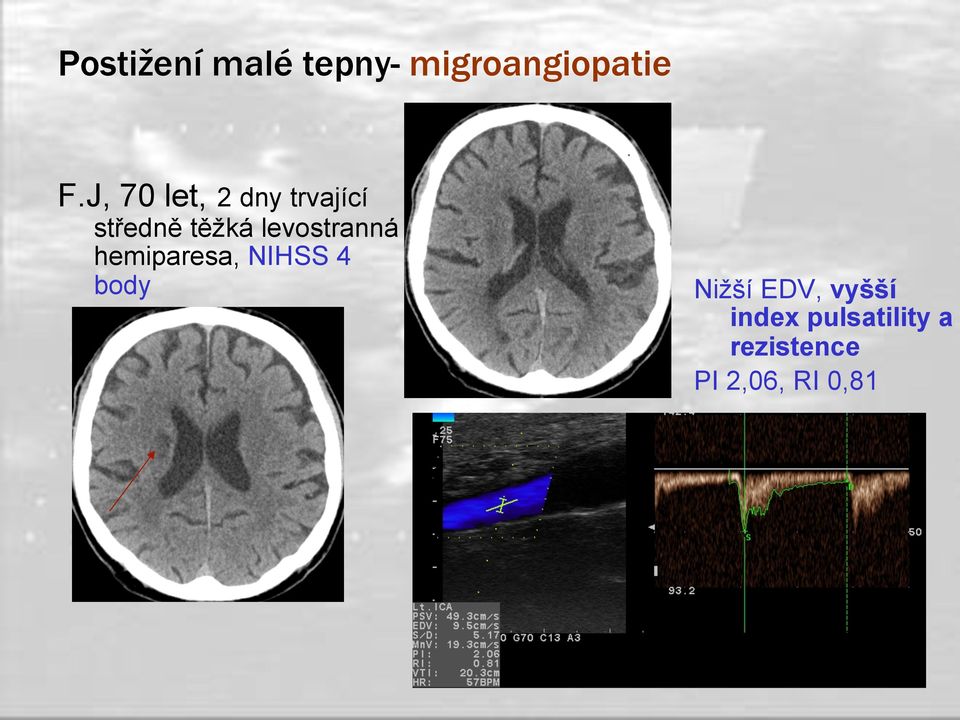 levostranná hemiparesa, NIHSS 4 body Nižší