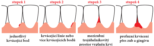 ale současně velmi citlivý ukazatel zánětu dásní. PBI se zaměřuje na hlavní projev gingivitidy, a to na krvácení.