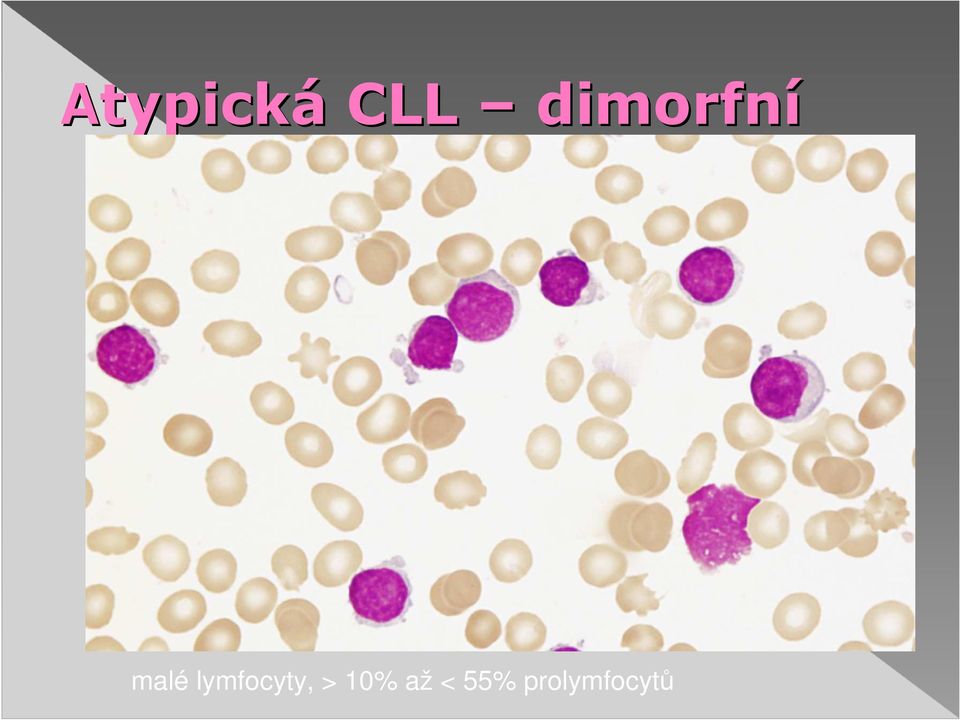 lymfocyty, > 10%