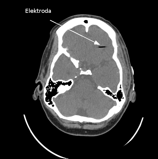 Obr. 5.8: Transverzální řez pacientského snímku z počítačové tomografie s implantovanými elektrodami. V současné době je standardní postup odečítat souřadnice jednotlivých kontaktů manuálně.