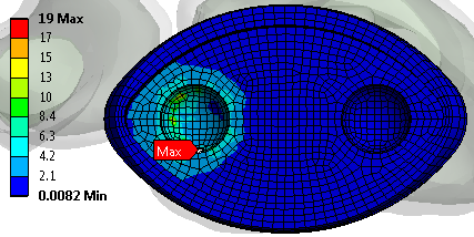 Obr. 13.113 ZPI_N - redukované napětí HMH [MPa] na fixačním šroubu v mediálním směru Obr. 13.114 ZPI_N - redukované napětí HMH [MPa] na fixačním šroubu v laterálním směru Šroub v laterárním směru je v i člunkové a mnohohranné menší.