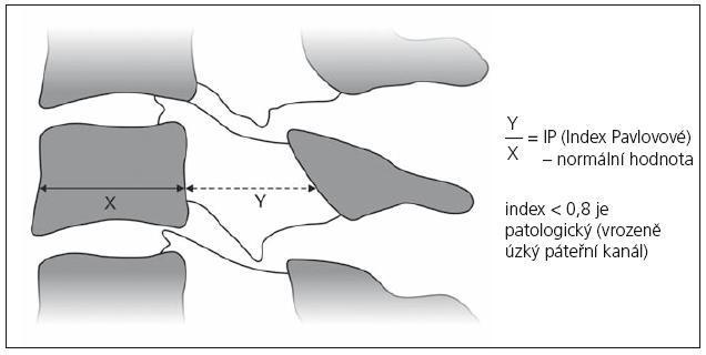 Index Pavlovové = podíl šíře páteřního kanálu k šíři