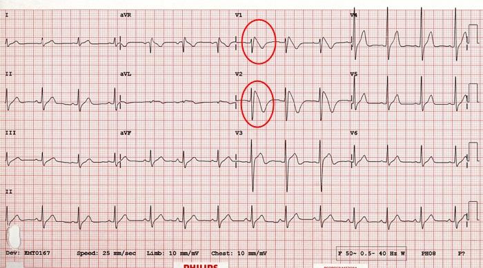 RBBB + elevace ST ve V1-3, elevace J bodu > 2mm, konkávní elevace ST, sedlovité