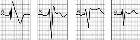 Brugada syndrom Prevalence 1-10/ 1000 (jižní Asie) AD Věkově i pohlavně vztažená penetrance, muži 8x KT 25-55 rokem, během odpočinku a spánku >12 genů EKG I. typ II. typ III.