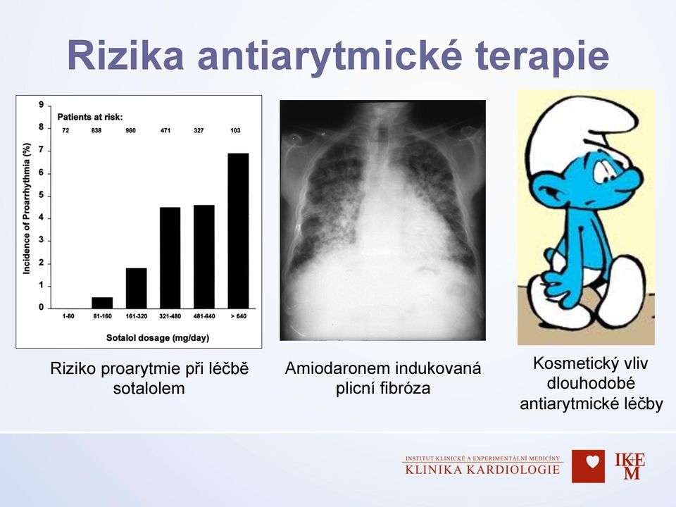 Amiodaronem indukovaná plicní fibróza