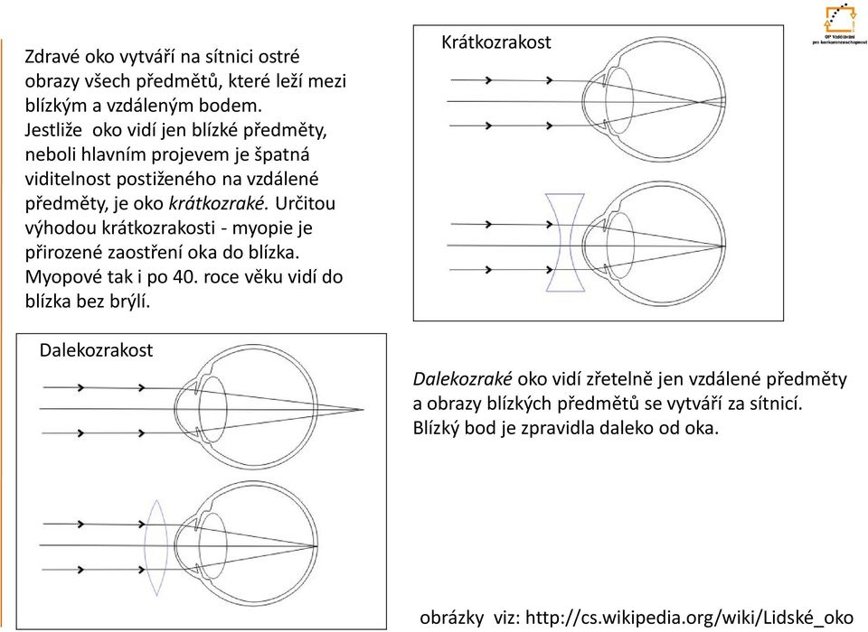 Určitou výhodou krátkozrakosti - myopie je přirozené zaostření oka do blízka. Myopové tak i po 40. roce věku vidí do blízka bez brýlí.