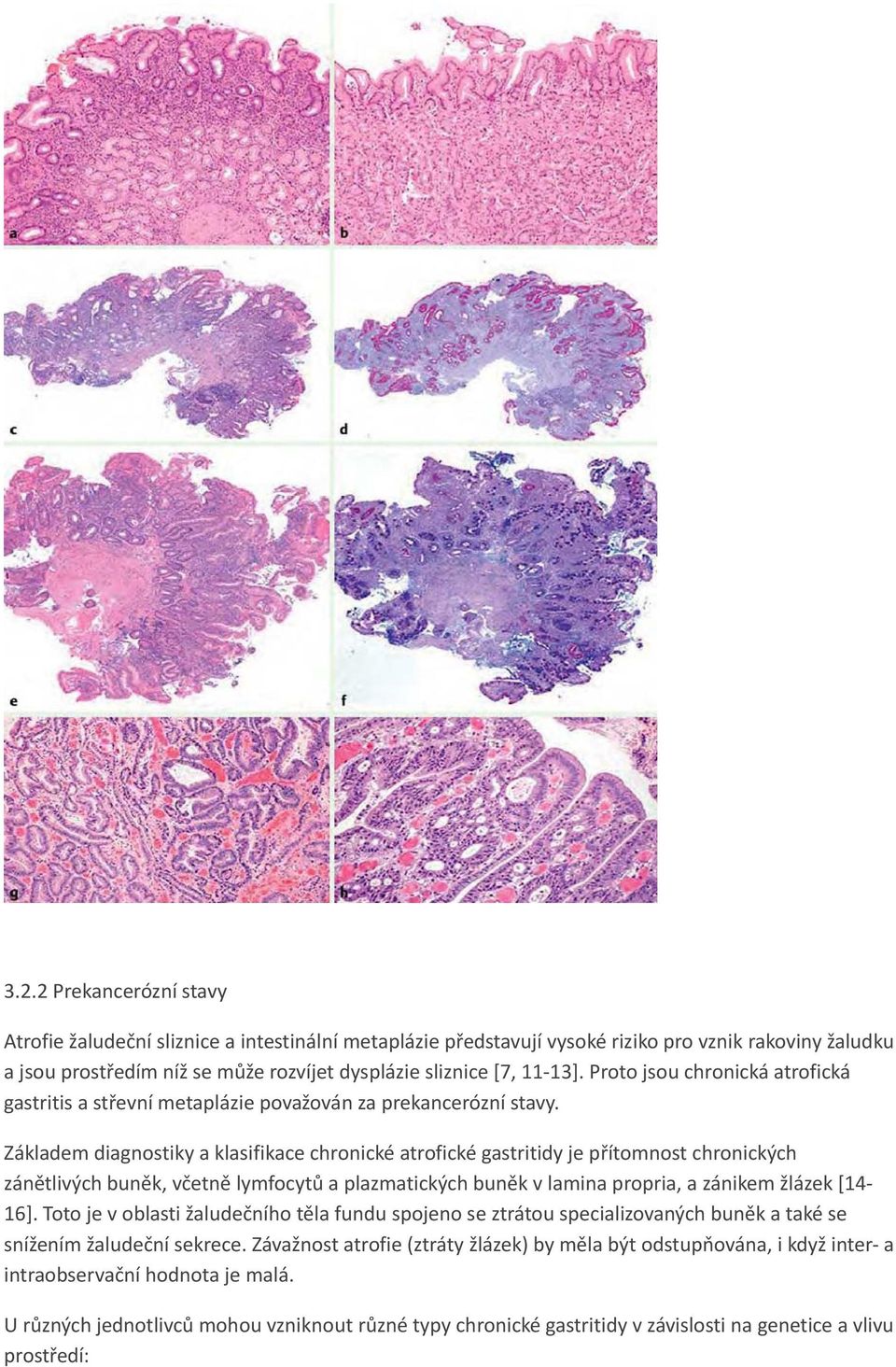 Základem diagnostiky a klasifikace chronické atrofické gastritidy je přítomnost chronických zánětlivých buněk, včetně lymfocytů a plazmatických buněk v lamina propria, a zánikem žlázek [14 16].