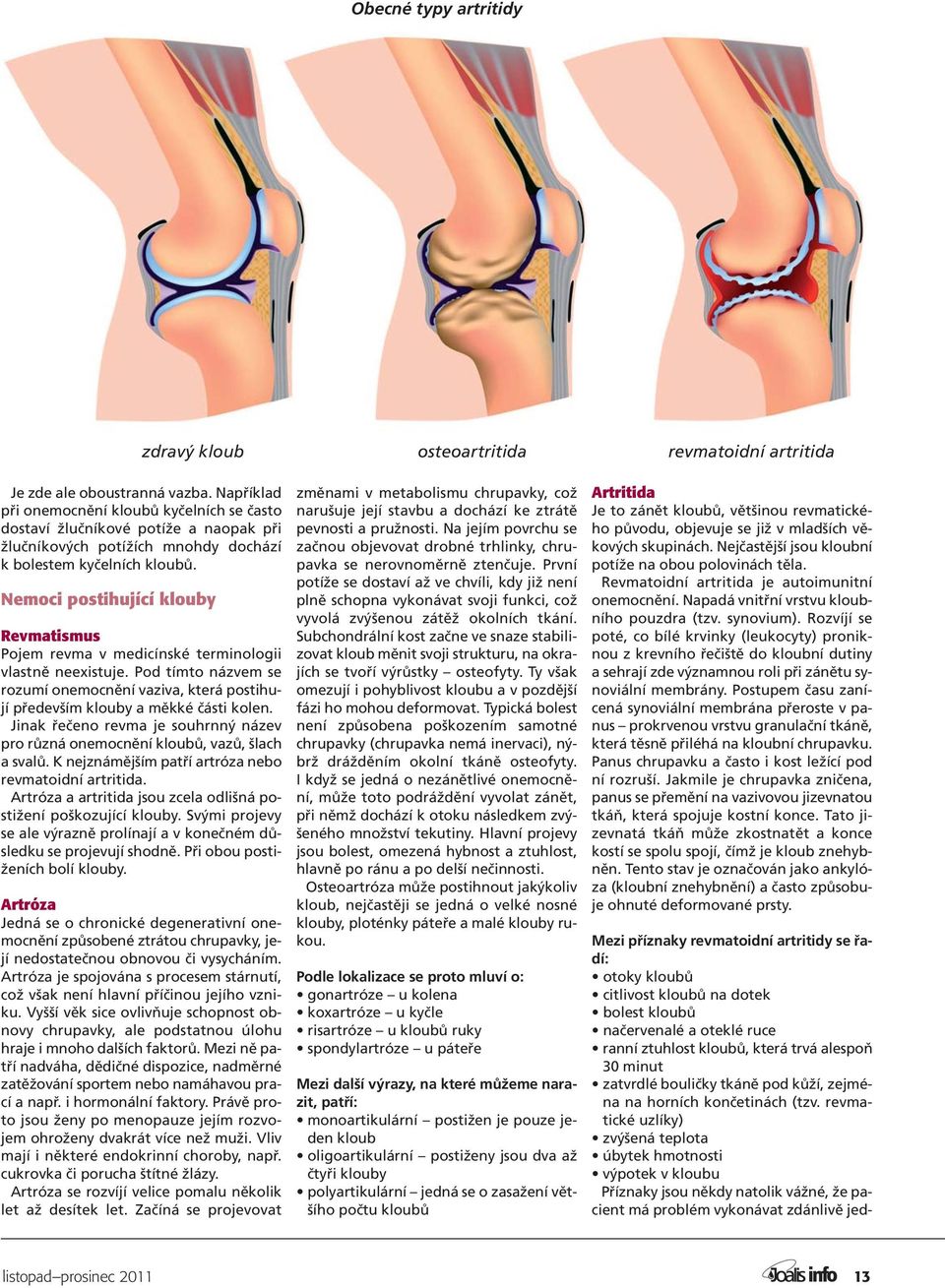 Nemoci postihující klouby Revmatismus Pojem revma v medicínské terminologii vlastně neexistuje. Pod tímto názvem se rozumí onemocnění vaziva, která postihují především klouby a měkké části kolen.