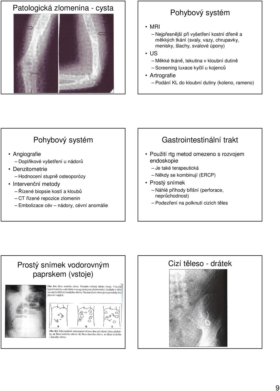 Intervenční metody Řízené biopsie kostí a kloubů CT řízené repozice zlomenin Embolizace cév nádory, cévní anomálie Gastrointestinální trakt Použití rtg metod omezeno s rozvojem endoskopie Je také